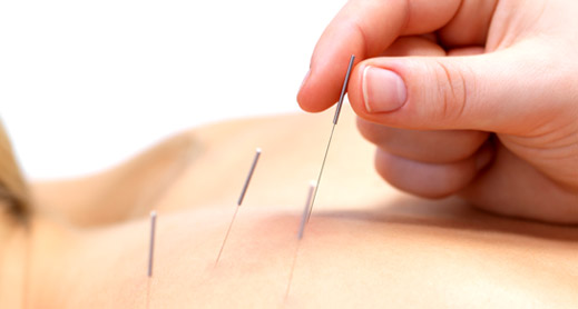 acupuncture treatment